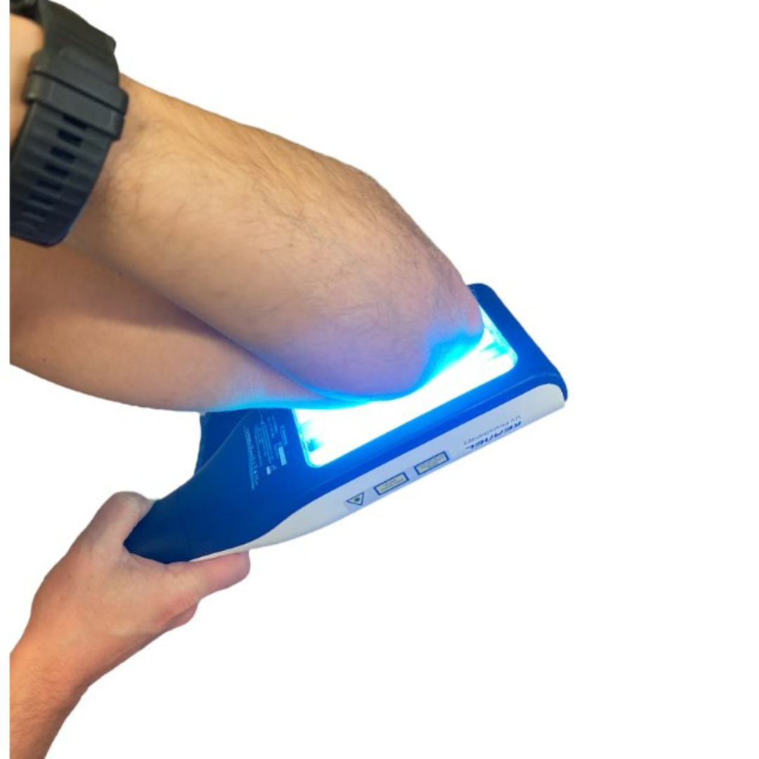 DermaLuma Portable UVB Therapy Lamp for Psoriasis and Vitiligo at Home - OpalDwell