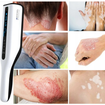 DermaLuma Portable UVB Therapy Lamp for Psoriasis and Vitiligo at Home - OpalDwell