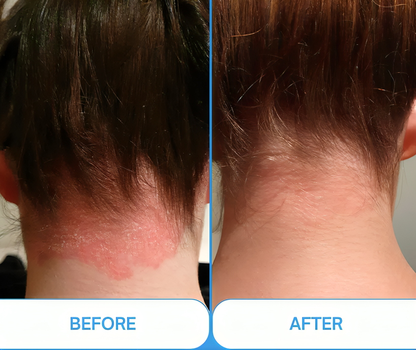 Lumara Pocket UVB Light Therapy Lamp 311nm For Psoriasis And Vitiligo - OpalDwell