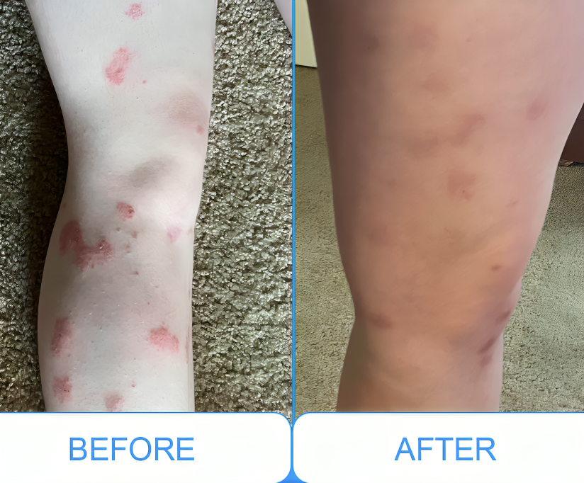 DermaLuma Portable UVB Therapy Lamp for Psoriasis and Vitiligo at Home - OpalDwell
